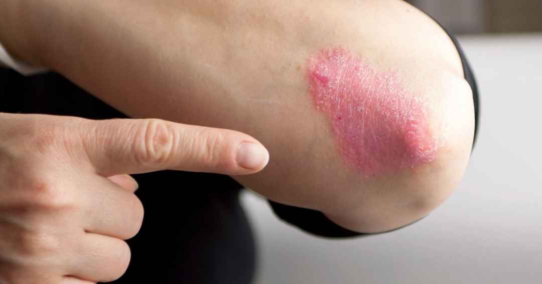 psoriasi psoriasi