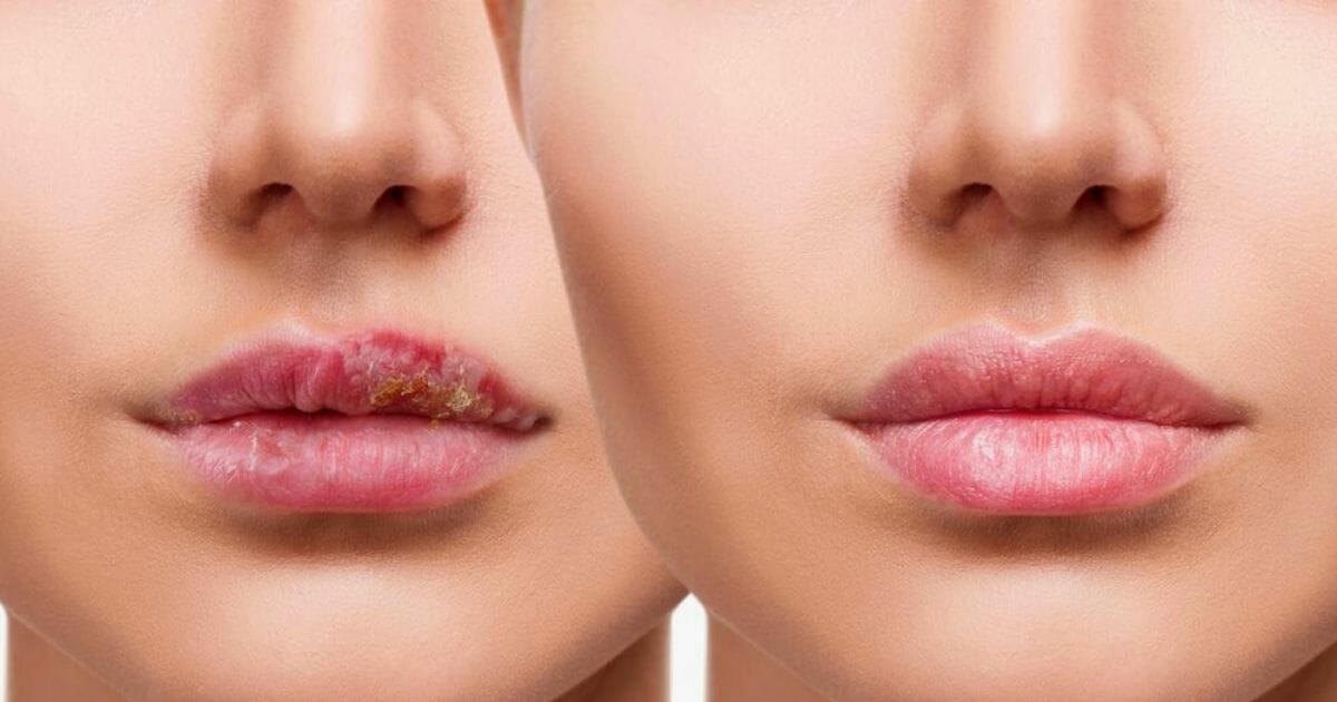 Rimedi naturali per herpes alla bocca: scopri i consigli