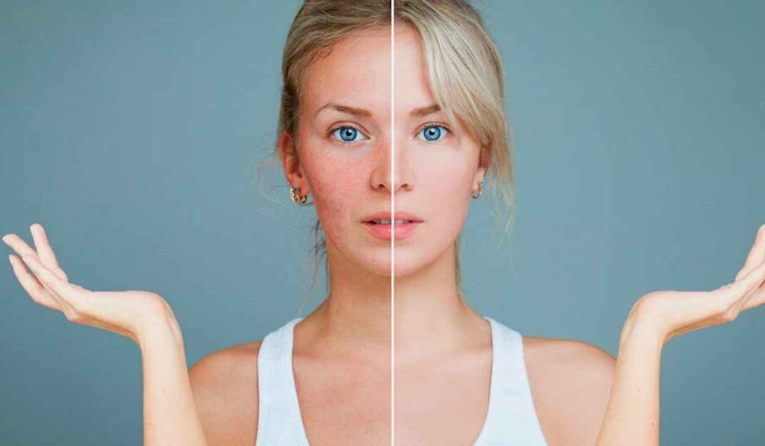 Come diminuire l’arrossamento della pelle?