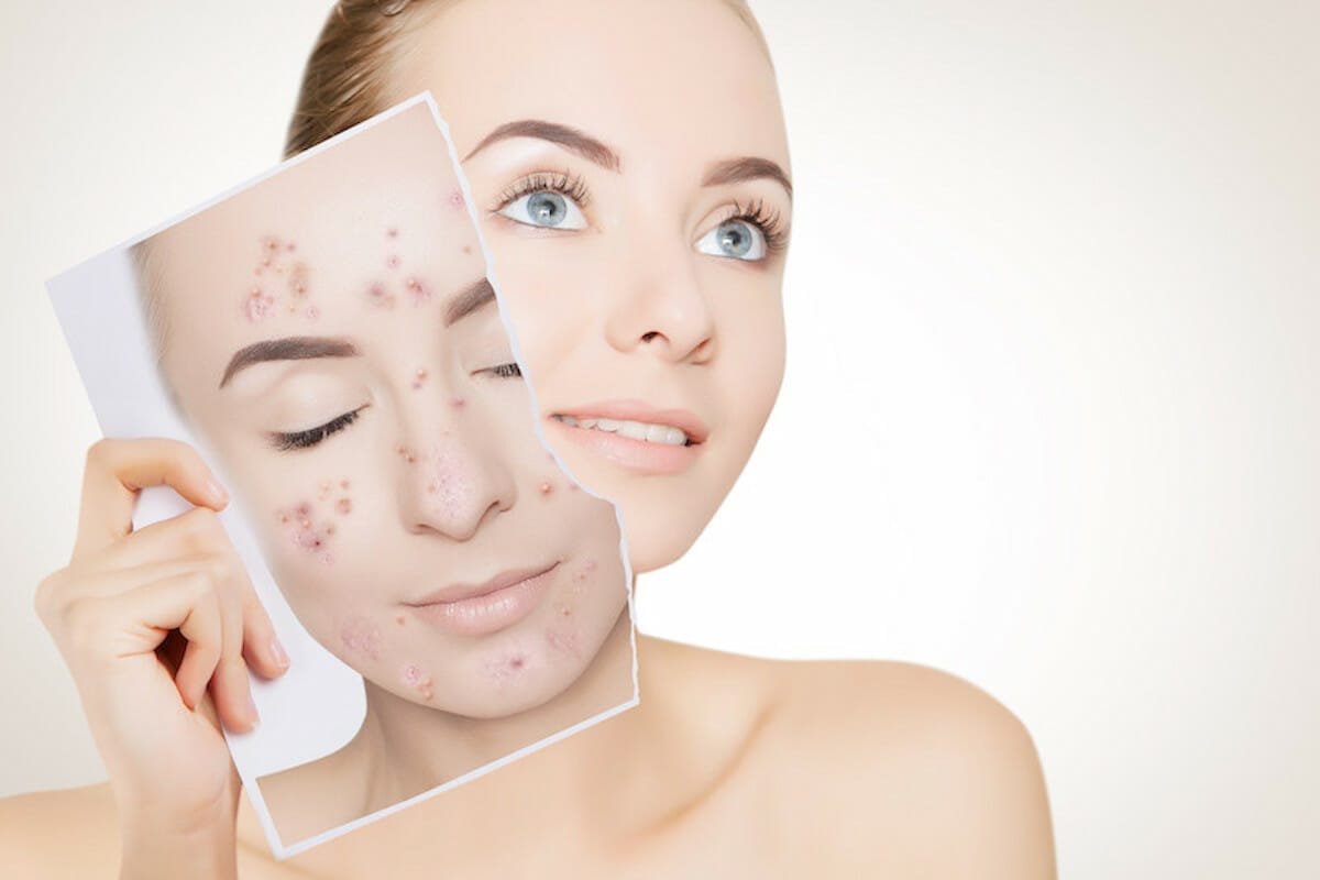 Come si cura l’acne? Scopri i colloidali che ti aiutano a combatterla