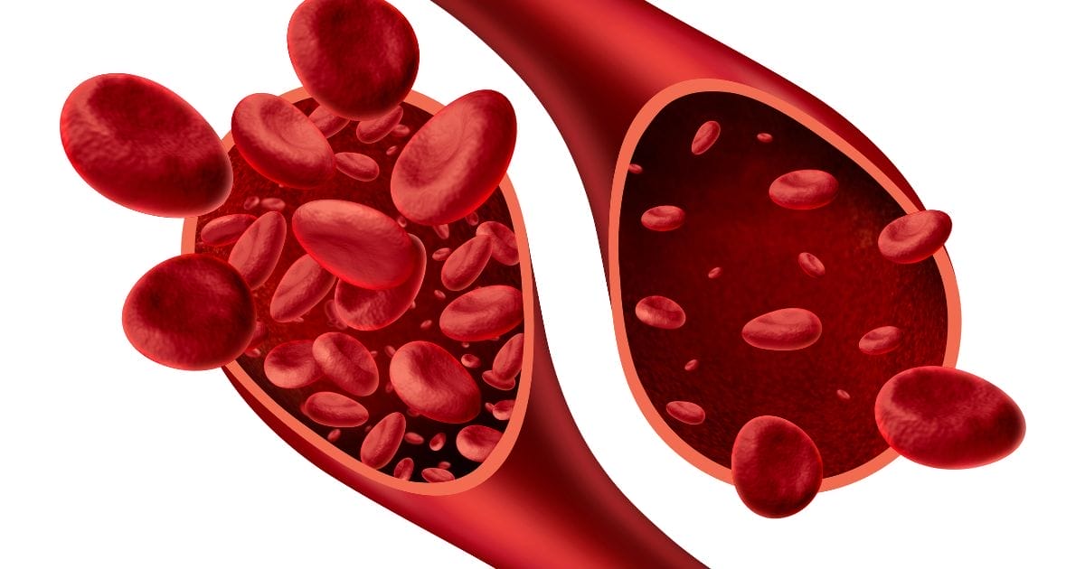 Anemia sideropenica: sintomi, cause e colloidali utili